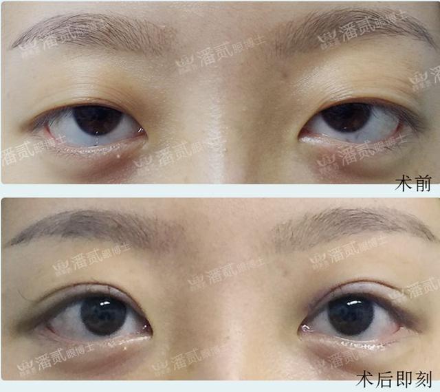 三白眼是什么意思，下三白眼的女人（下睑下至注意分寸）