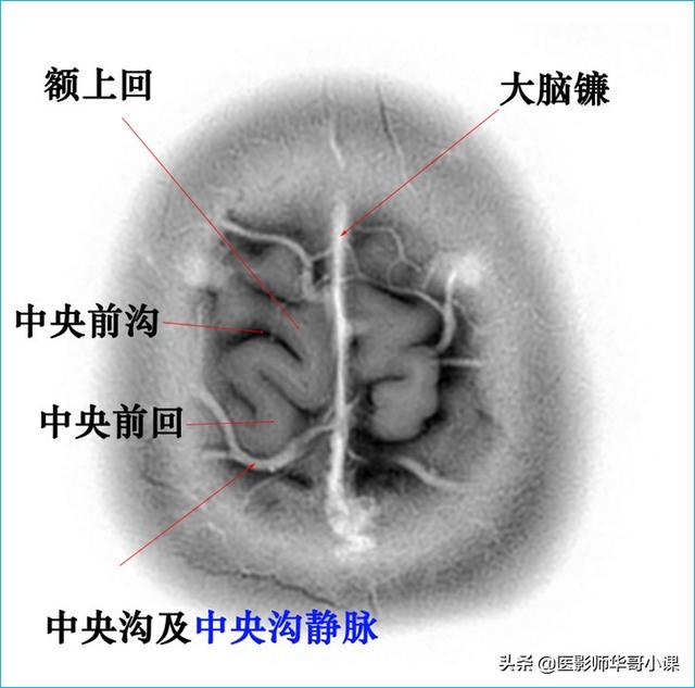 头颅ct解剖图，头部骨骼结构图（颅脑磁共振MRI解剖结构以及高清图谱）