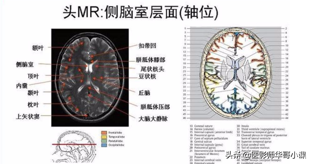 颅脑mri(头部MRI)插图(70)