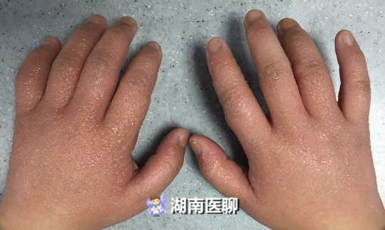 手掌皮肤病的种类图片大全,女童双手长满水疱
