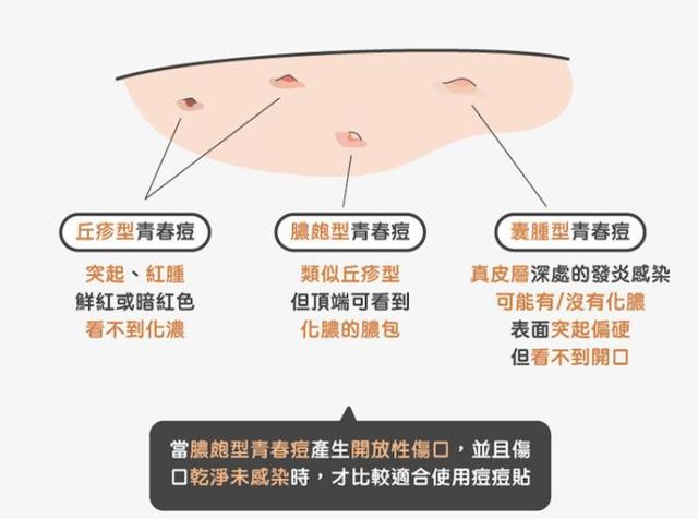痘痘贴怎么用，脸上长痘痘涂什么药膏（痘痘贴管用吗？怎么用才合适）