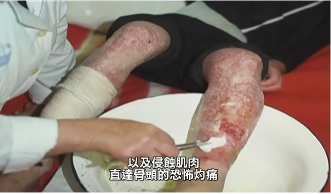 83天,大内久看着自己成为一具"活尸"