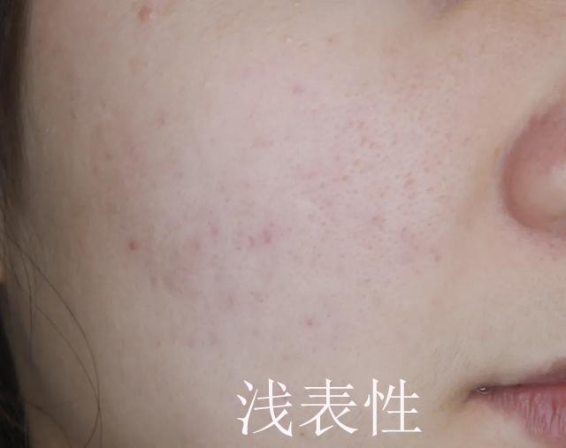 痘坑一辈子都不会好吗，激光祛痘印痘坑多少钱一次（能否选择‘’无恢复期‘’的治疗项目）