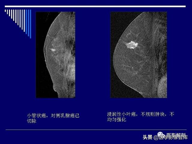 乳房解剖学基础知识，乳腺解剖及乳腺各病变影像诊断与鉴别