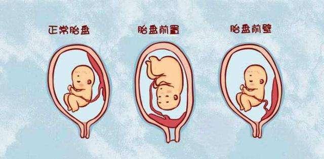 胎盘前置怎么办，前置性胎盘怎么办（胎盘过低是怎么回事儿）