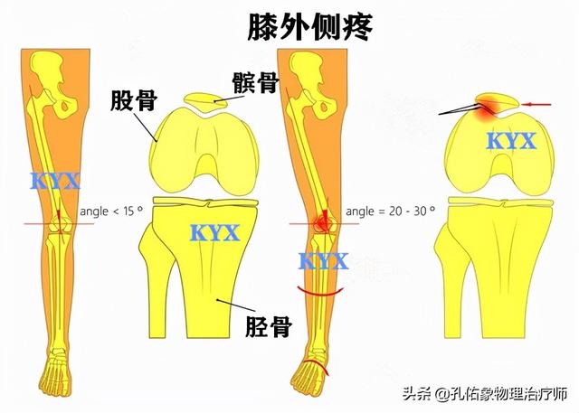 膝盖弯曲时疼痛会自愈吗，跑步膝盖疼能自愈吗（膝关节为什么疼痛）