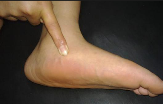 平足可以当兵吗，平足为什么不能当兵（为什么扁平足无法满足征兵的条件）