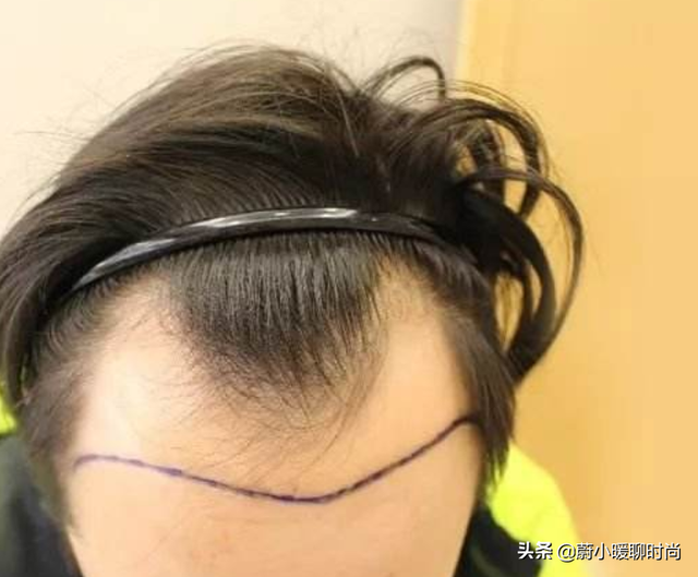 什么是美人尖，“美人尖”对美人的影响很大