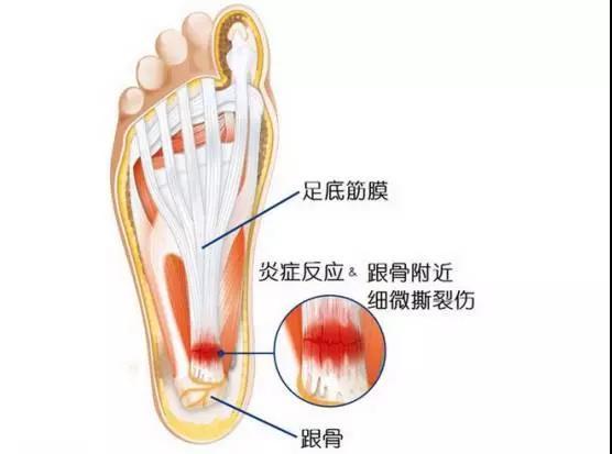 脚筋疼怎么办最快最有效，脚筋疼了怎么恢复最快（什么是足底筋膜炎）