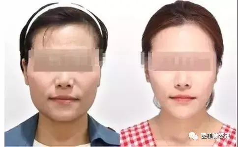 玻尿酸去皱纹好吗，玻尿酸去皱纹多少钱（玻尿酸解决静态皱纹）