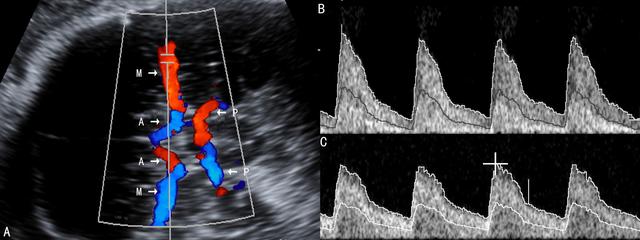 sga是什么意思，毁人之国而非久也的久是什么意思（胎儿超声多普勒检查应用2）