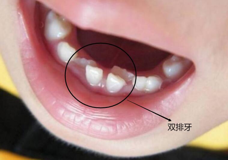 儿童换牙顺序图20颗(最全儿童换牙时间表)