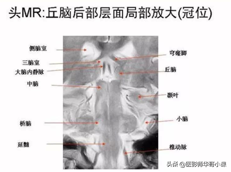 颅脑mri(头部MRI)插图(60)