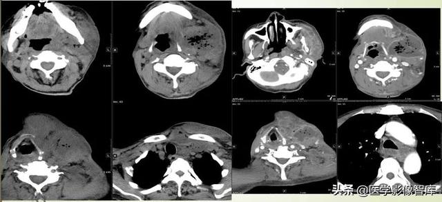 颞间隙感染，颞间隙感染切开部位（颌面部间隙感染影像诊断及各间隙解剖介绍）