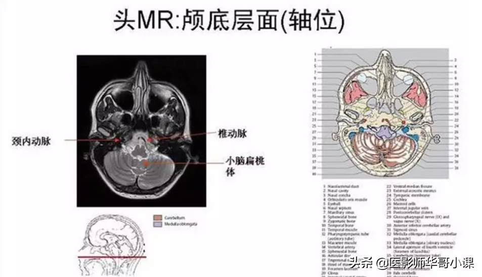 颅脑mri(头部MRI)插图(81)