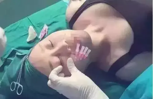 线雕隆鼻是什么，线雕隆鼻是什么材料（北大整形教授张宗学-什么是线雕）