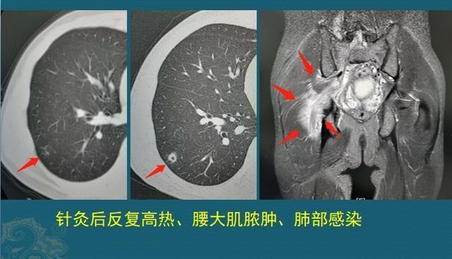 碘酒过期了还能用吗，过期了的碘酒还能不能用（硬扛3天不吃抗生素必后悔）