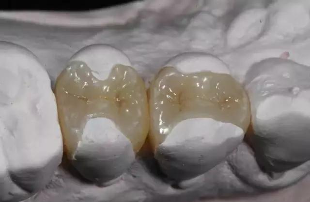 嵌体和补牙的区别，嵌体与补牙之间的区别（有种补牙叫嵌体）