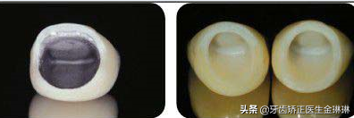 美白牙贴对假牙有用吗 贴美白牙贴有口水怎么办，美白牙贴对假牙有用吗（烤瓷牙变黄可以美白吗）