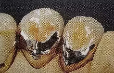 纯钛烤瓷牙多少钱一颗(牙医教你如何选择烤瓷牙的材料)