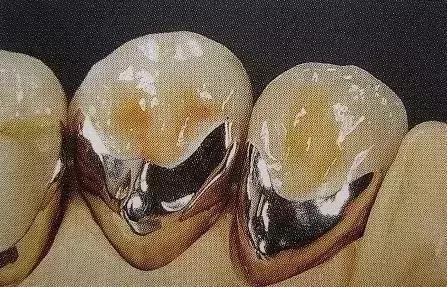 烤瓷牙是怎么做的，烤瓷牙是怎么做的伤牙吗（牙医教你如何选择烤瓷牙的材料）