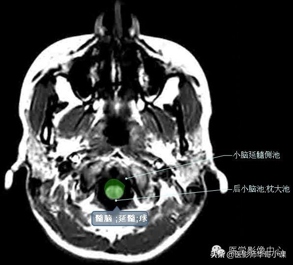 颅脑mri(头部MRI)插图(42)