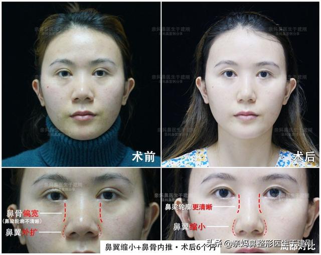 隆鼻后后遗症有哪些呢 隆鼻手术后注意事项，隆鼻后后遗症有哪些呢（我来告诉你隆鼻术后运动的真相）