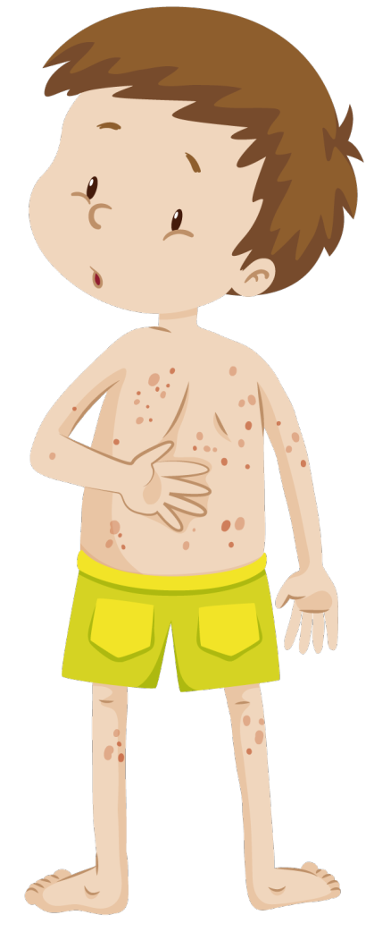 轻度单纯性紫癜图片,儿童单纯性紫癜(过敏性紫癜的诊断和鉴别 1>)