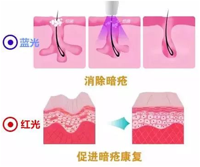 长痘痘的人伤不起，为什么人会长痘痘祛痘还很困难（刷酸仍是功不可没）