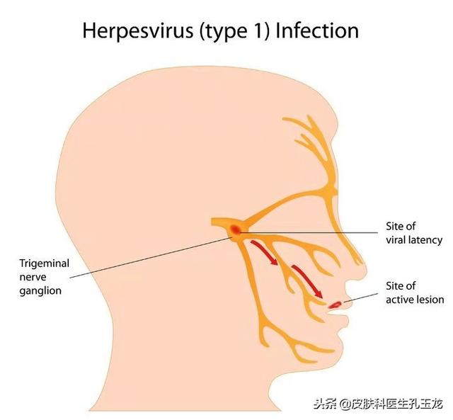 嘴唇上长疱疹图片，嘴唇长疱疹怎么治疗（嘴唇上火的真相——单纯疱疹）