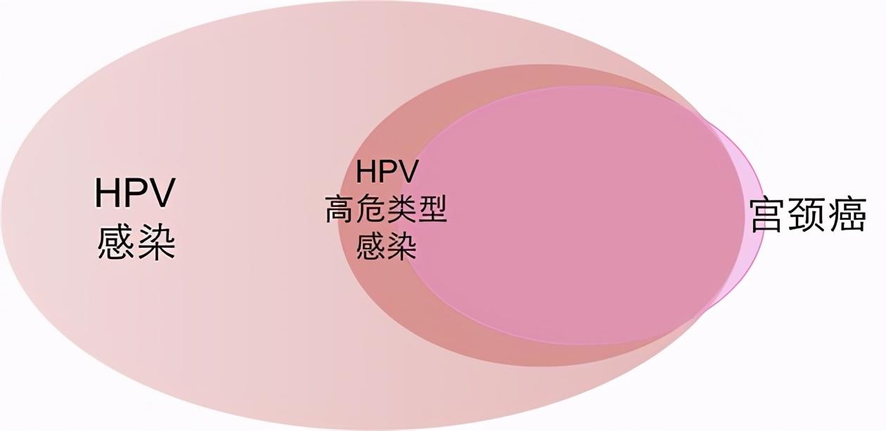 hpv即人乳头瘤病毒,分为很多种亚型,大量研究结果发现高危亚型hpv感染