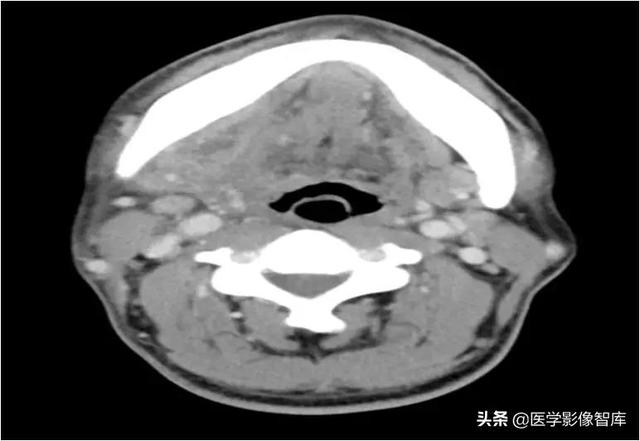 颞间隙感染，颞间隙感染切开部位（颌面部间隙感染影像诊断及各间隙解剖介绍）