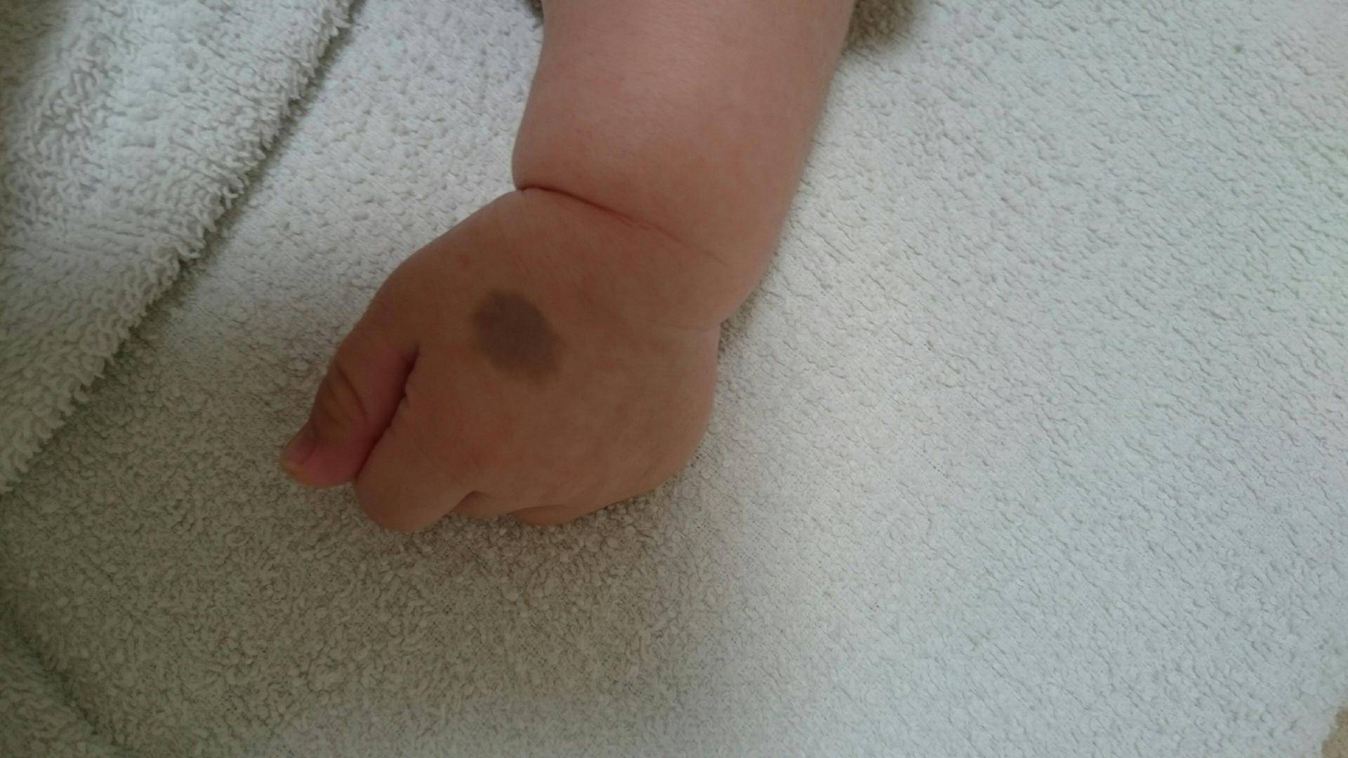 蒙古斑也叫作骶部色素斑,在东亚地区的孩童身上会经常见到.