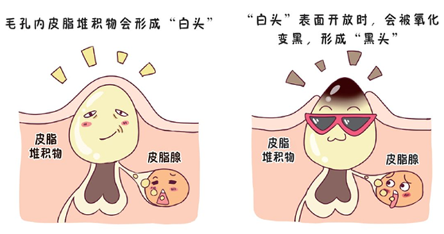 长痘痘的人伤不起，为什么人会长痘痘祛痘还很困难（刷酸仍是功不可没）