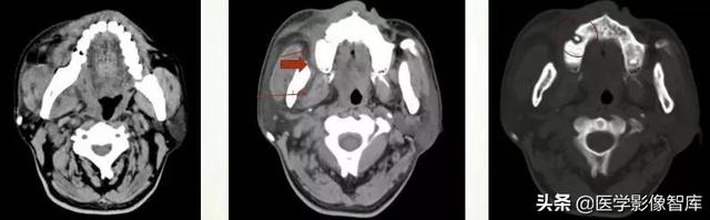 颞间隙感染，颞间隙感染切开部位（颌面部间隙感染影像诊断及各间隙解剖介绍）