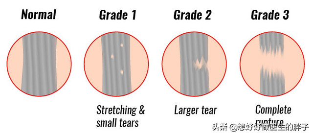 筋痛怎么办，膝盖后面的腿窝筋痛怎么办（肌腱和韧带有什么区别）