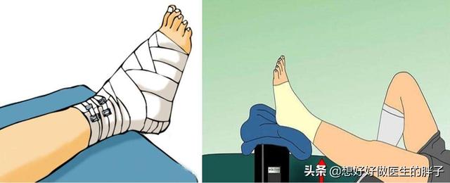 脚踝骨折康复训练6种简单方法，踝关节运动损伤的恢复训练（踝关节骨折术后不同时间段康复锻炼的一点建议）