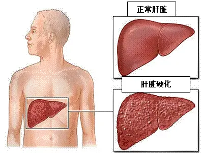 乙肝表面抗体高是什么意思，乙肝表面抗体高是什么意思838.26（乙肝核心抗体阳性是什么意思）
