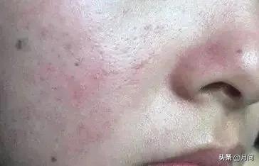 敏感肌的特征，如何判断自己是敏感肌肤