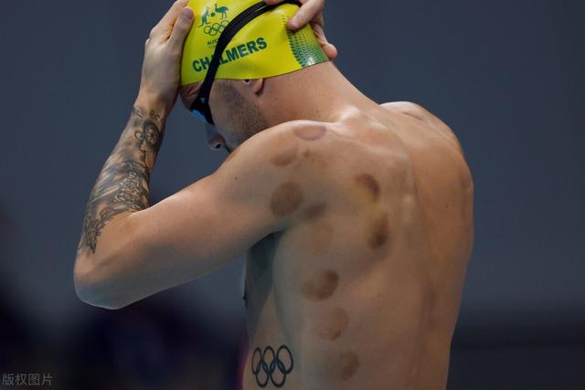 拔火罐颜色，拔火罐颜色越深湿气越重吗（拔罐，你拔出了什么）