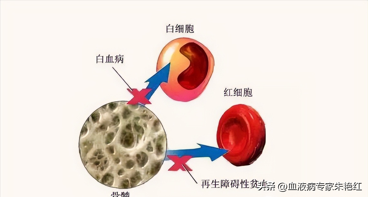 再生障碍性贫血和白血病哪个严重(再生障碍性贫血是大病吗)