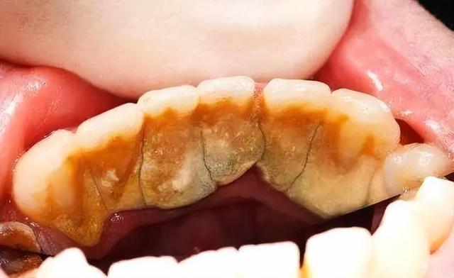 牙粉的使用方法，每天几毛钱就能轻松解决