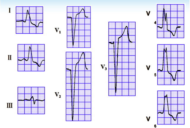 什么是大炮音，大炮音是怎样产生的（心律失常<五>）