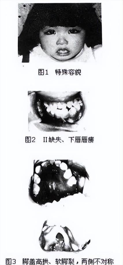 蓝妮妮是歌舞伎面谱综合征，歌舞伎综合症宝宝照片（大眼睛、尖下巴、精灵耳…长得太美也是一种病）