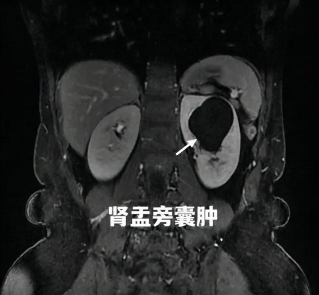 肾囊肿最佳治疗方法，肾囊肿最佳治疗方法有什么（肾囊肿治疗新方法）