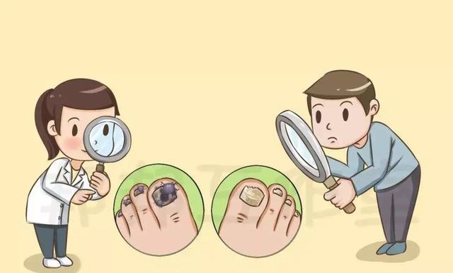 灰指甲刚开始的图片,灰指甲图片(“灰指甲”长啥样) 灰指甲刚开始的图片,灰指甲图片(“灰指甲”长啥样)