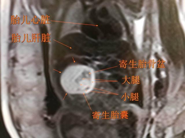 生孩子是从哪个部位生出来的，宫外孕的概率有多大（注定被“割”下的寄生胎）