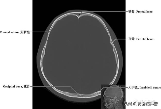 智力扣全套解法图解，智力扣九连环解法（详细标注版——颅脑CT正常解剖图谱）