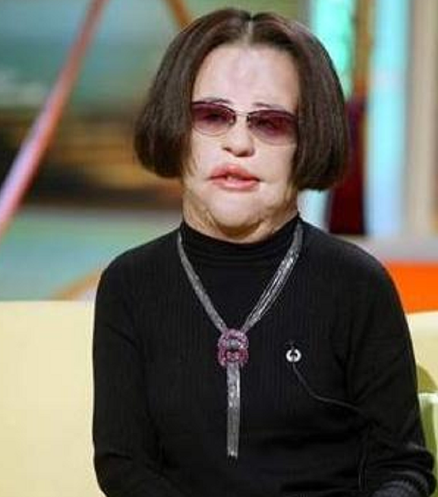 韩国女明星整容上瘾，自己向脸部注射食用油，9年无法闭眼睡觉