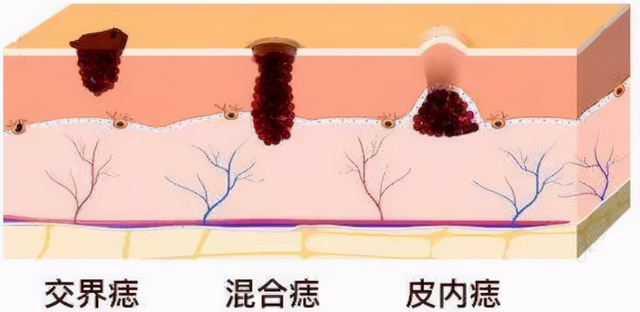 长红色的痣是有什么预兆，其中一种是肝癌的信号